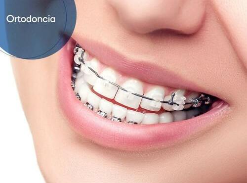 ortodoncia-blog-bracket