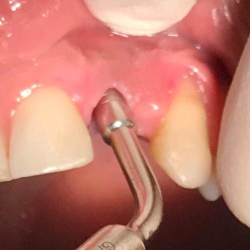 implante-procedimiento-2